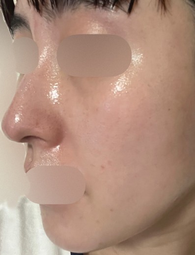 before photo: エレクトロポレーション, ルメッカ