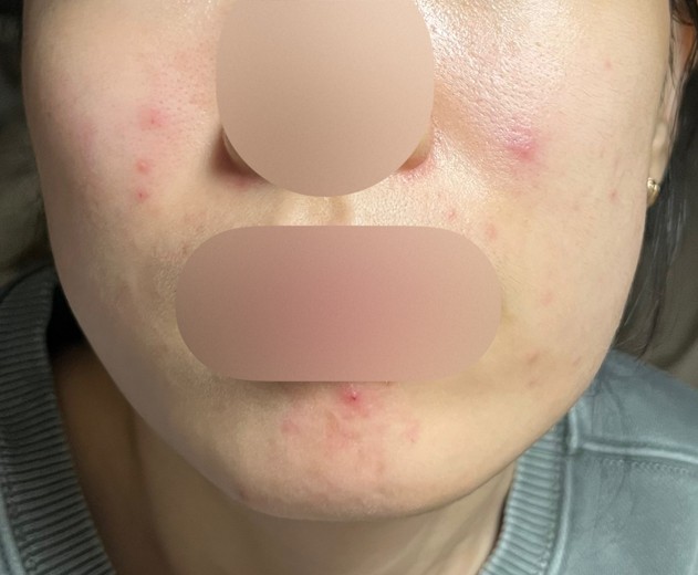 before photo: 여드름압출