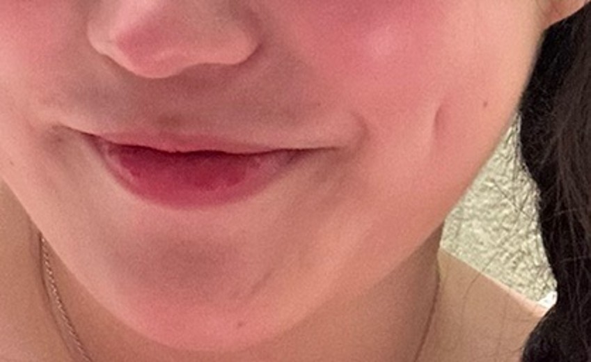 after photo: 보조개성형