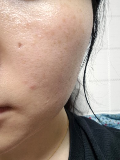 before photo: 레이저토닝