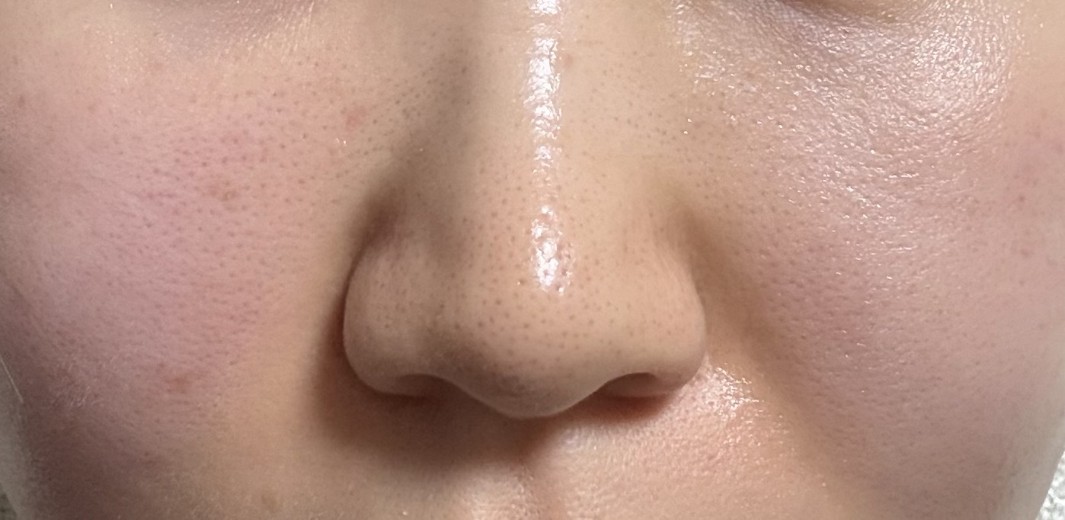 after photo: 脂肪溶解注射(顔)