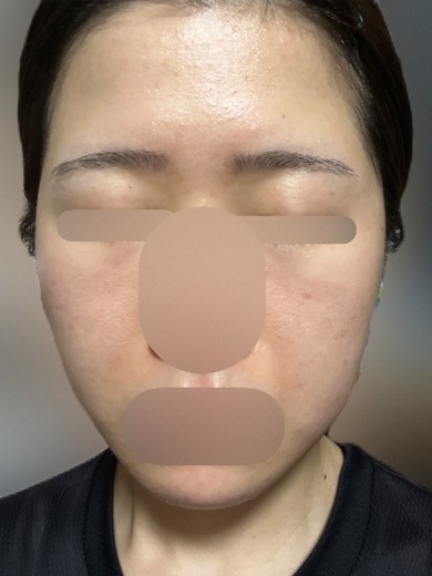 after photo: ピーリング, エレクトロポレーション