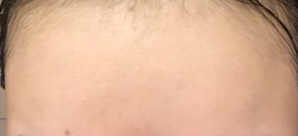 before photo: ハイドラジェントル