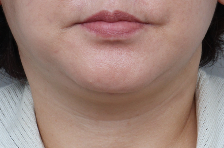 after photo: 실리프팅