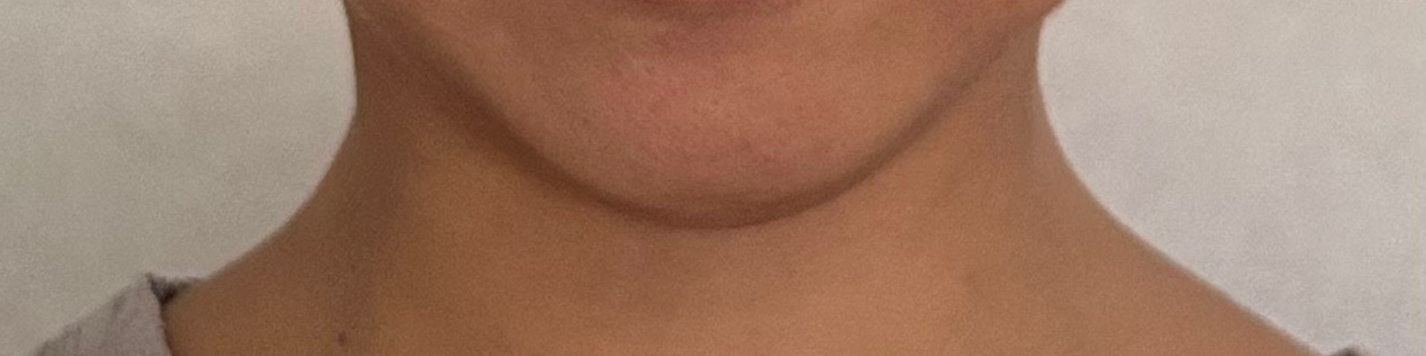 after photo: 브이올렛주사