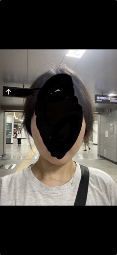 after photo: 윤곽주사, 얼굴지방분해주사