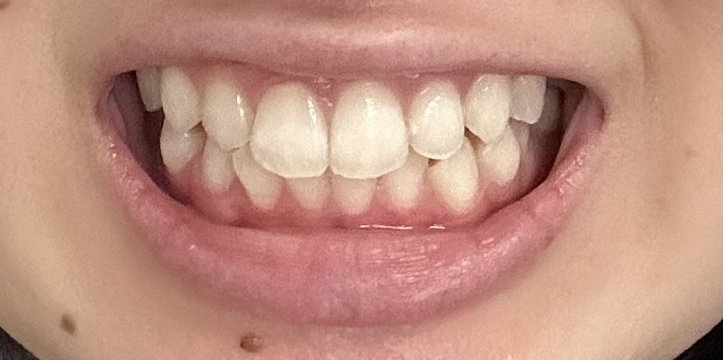 after photo: ホワイトニング