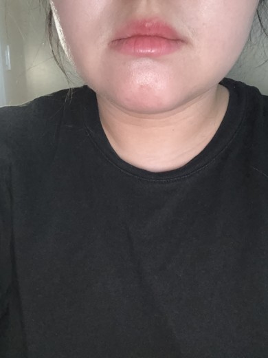 after photo: 사각턱보톡스