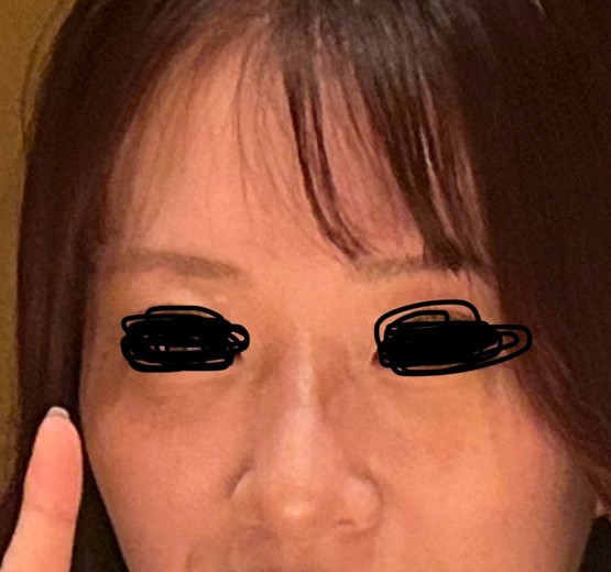after photo: フラクショナルレーザー, エレクトロポレーション