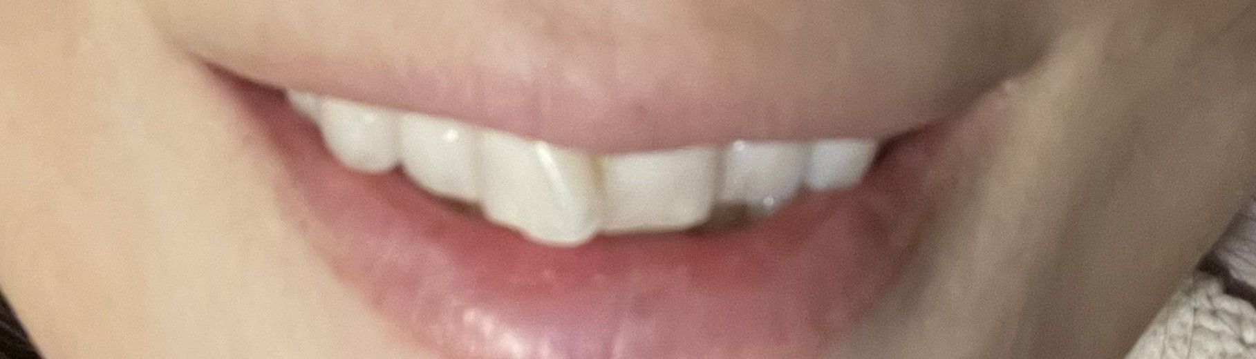 after photo: ホワイトニング