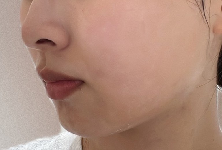 before photo: IPL(光/フォト治療), ルメッカ