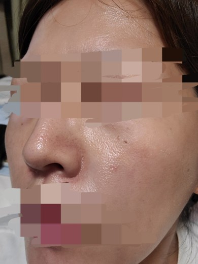 after photo: ハイドラフェイシャル, 診断・検査