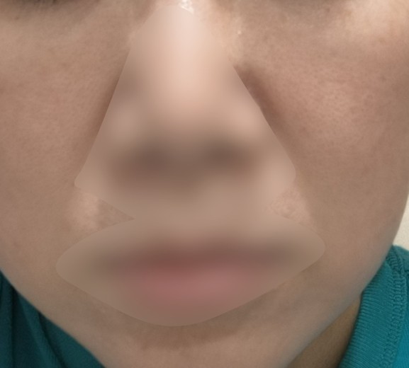 before photo: エクソソーム, エリシスセンス