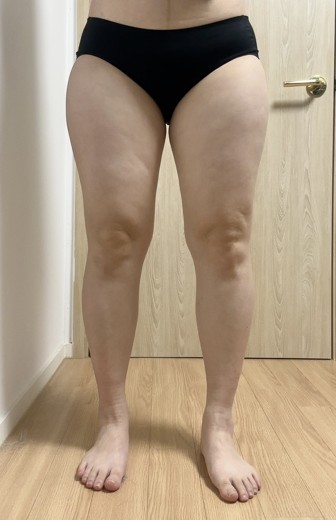 before photo: 허벅지지방흡입