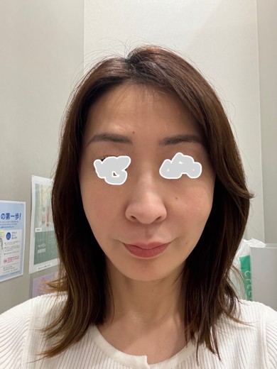 before photo: ボルニューマ