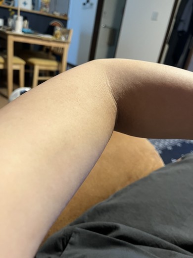 before photo: 脂肪溶解注射(腕)