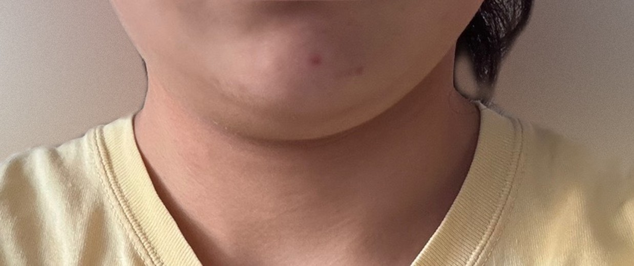 after photo: 脂肪溶解注射(顔)
