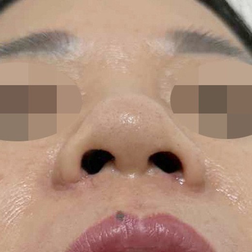 after photo: 콧볼축소