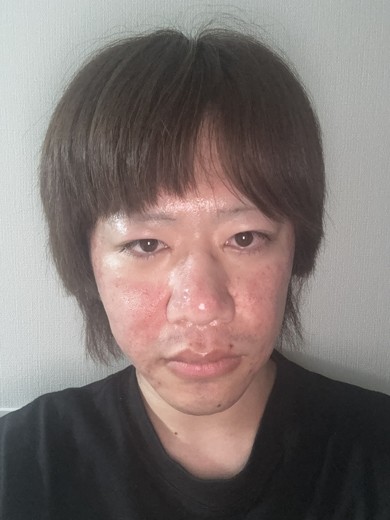 after photo: ダーマペン