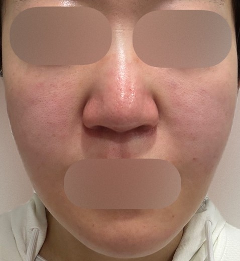 after photo: ジュベルック(Juvelook)