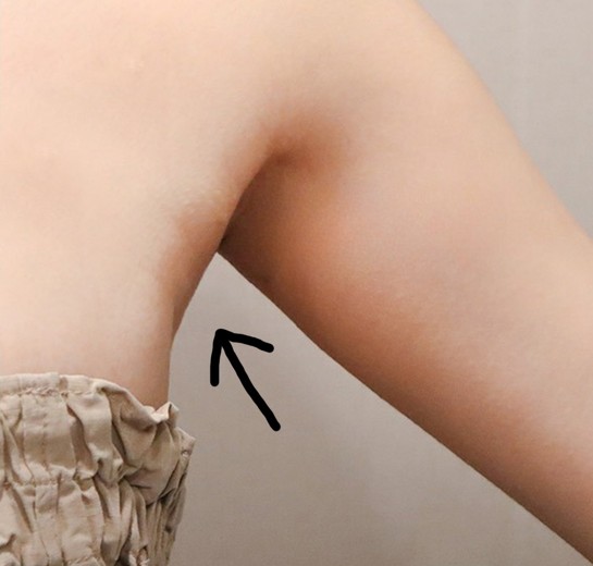 after photo: 팔지방분해주사, 옆구리지방분해주사