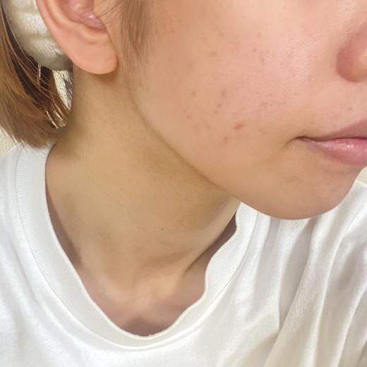 after photo: IPL(光/フォト治療)