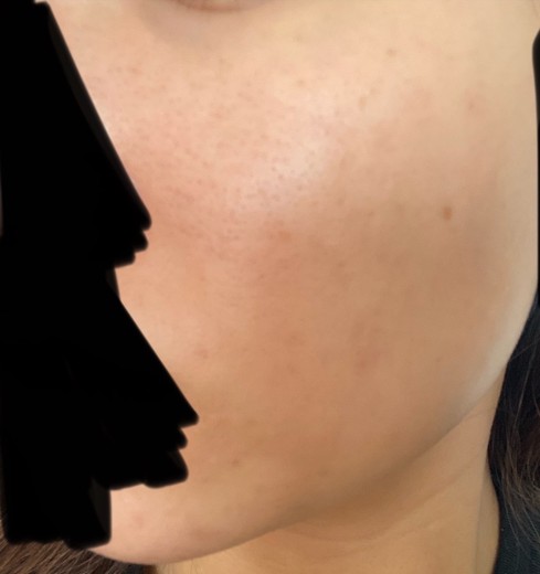 before photo: ダーマペン, ミラノリピール
