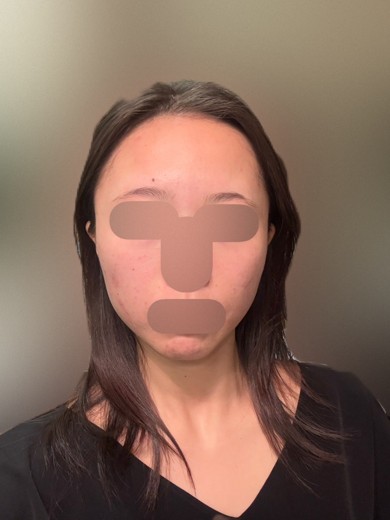 before photo: ダーマペン