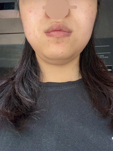 before photo: 여드름압출, 여드름주사