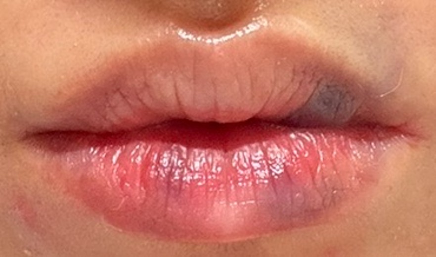 after photo: 필러제거주사