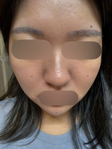 after photo: ハイドラフェイシャル