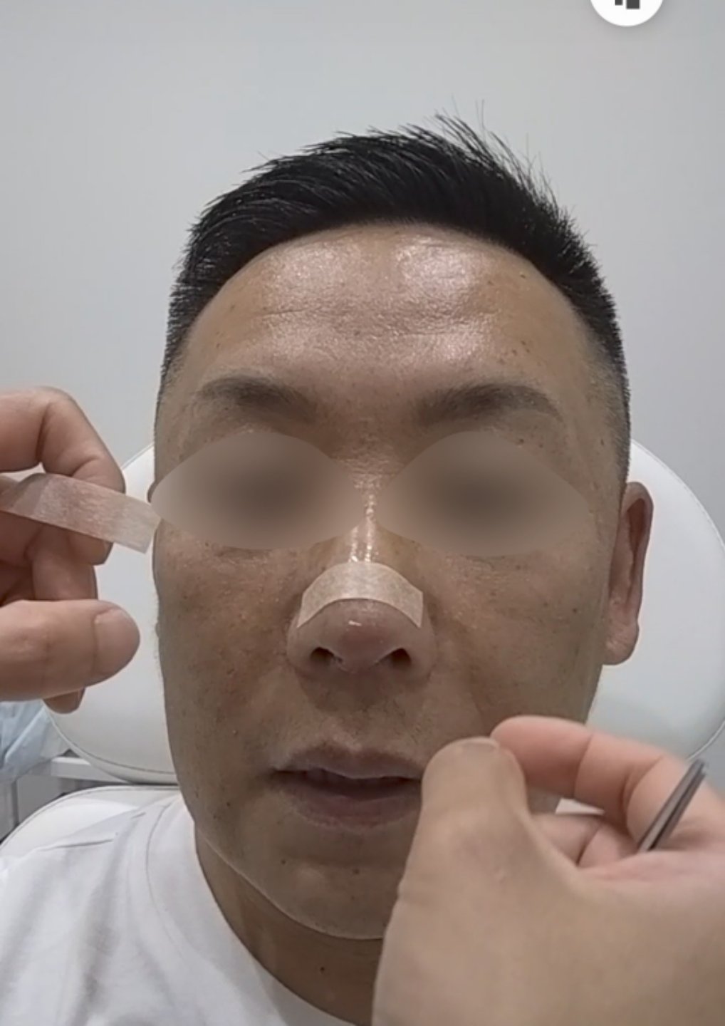 Ｃ【初手術限定】鼻先肋軟骨-ｵﾌﾟｼｮﾝから麻酔まで込々〖定額プラン〗 | BIKAN整形外科, image size:1018x1440