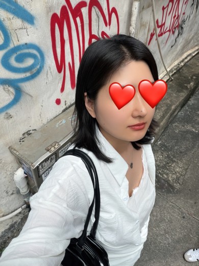 after photo: 콧대(보형물), 코끝(자가연골)