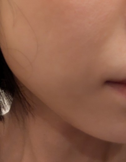 after photo: 糸リフト, メーラー/ジョール/バッカルファット除去
