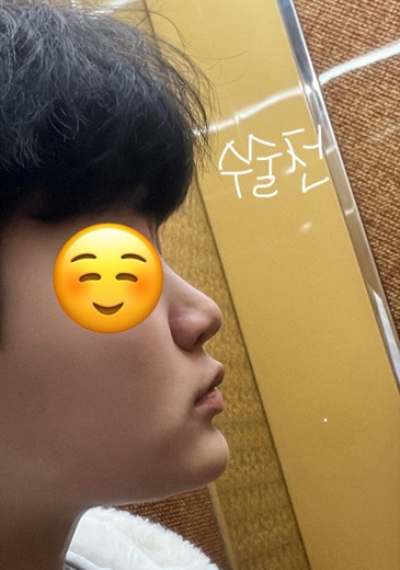 before photo: 비중격만곡증수술, 콧대(보형물), 코끝(자가연골)