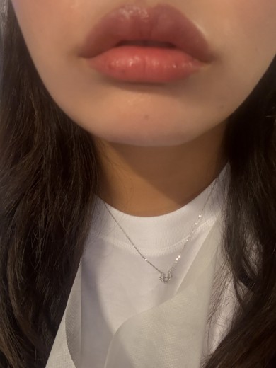 after photo: 입꼬리필러, 입꼬리보톡스