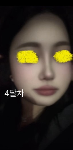 after photo: 콧대(보형물), 코끝(자가연골), 비후성비염수술