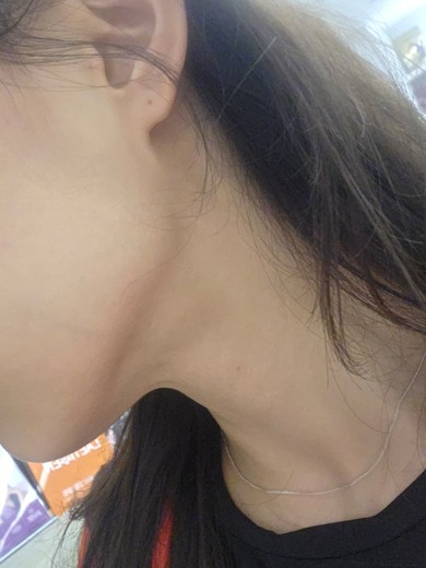 before photo: 침샘보톡스