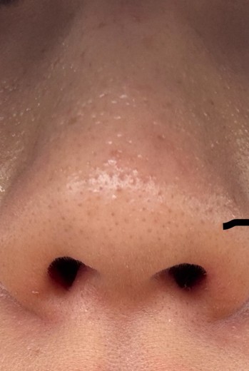 before photo: ダーマペン