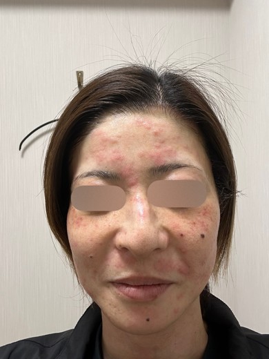 after photo: IPL(光/フォト治療), エレクトロポレーション
