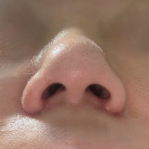 after photo: 콧볼축소, 복코교정(수술)