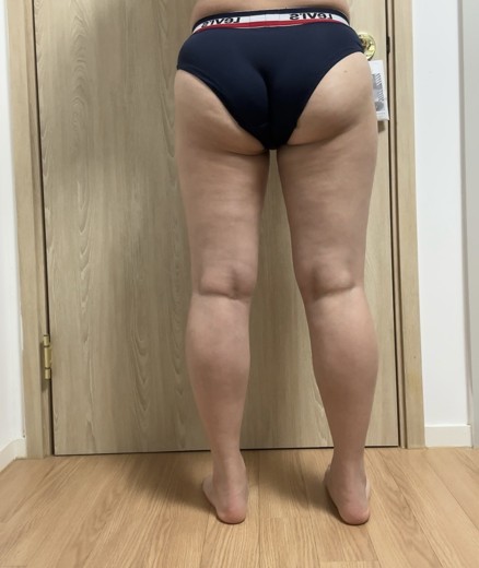 after photo: 허벅지지방흡입