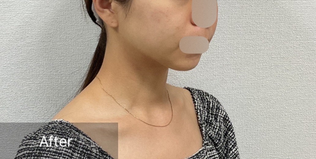 after photo: チタニウムリフト