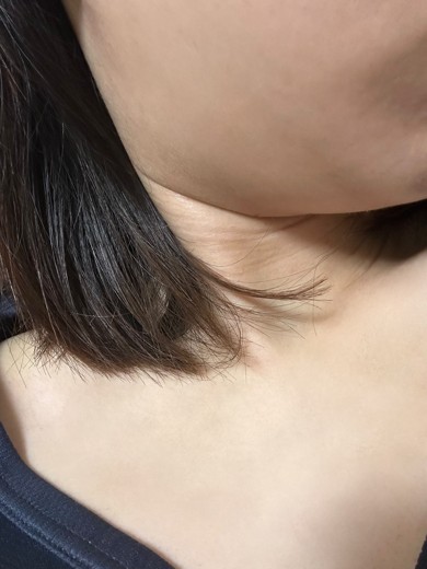 after photo: 脂肪溶解注射(顔)