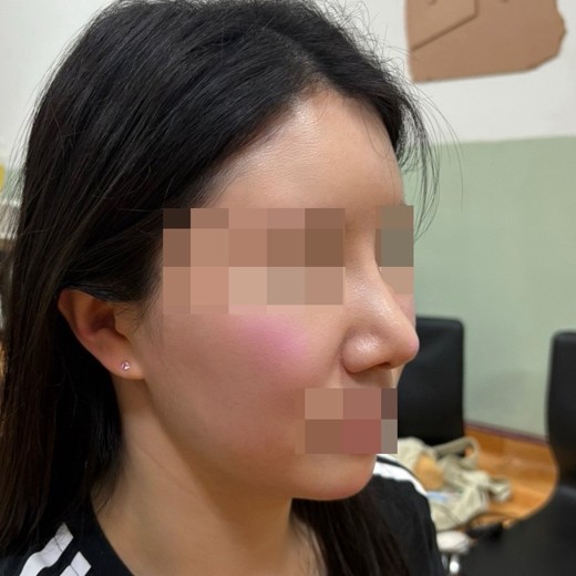 after photo: 코재수술, 콧대(보형물), 복코교정(수술)