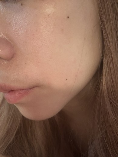 after photo: IPL(光/フォト治療)