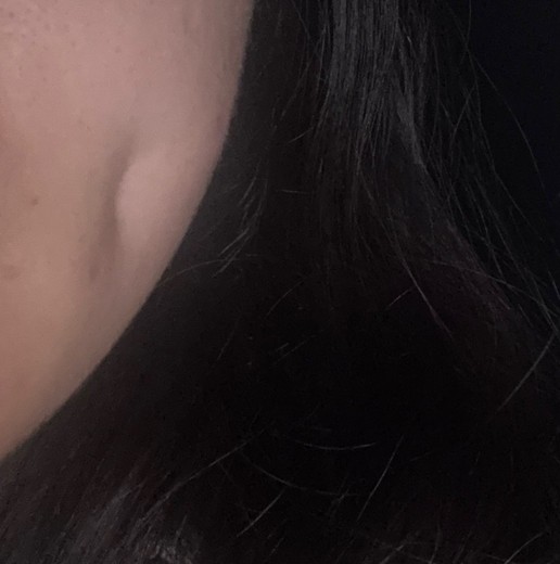 after photo: 보조개성형