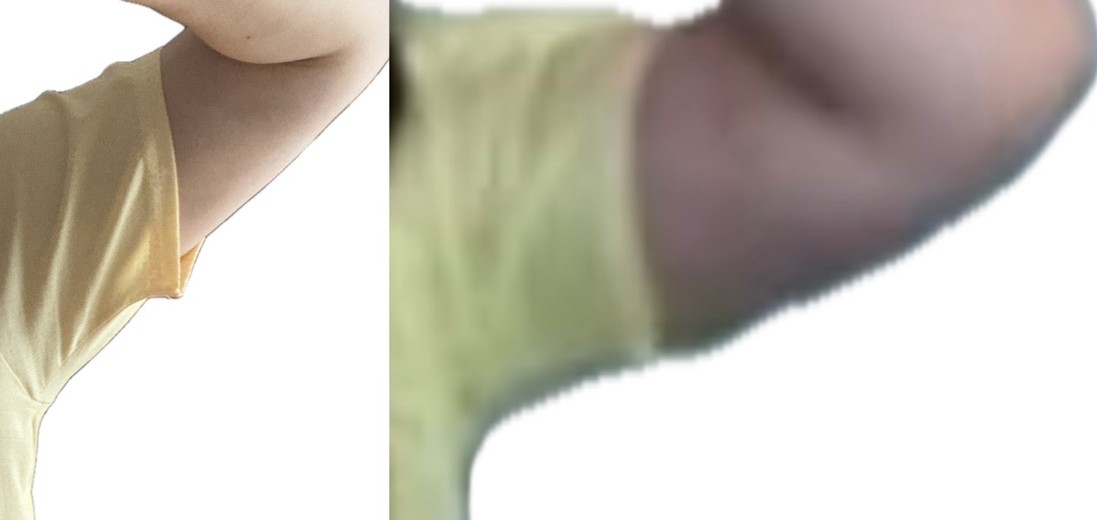 after photo: 팔지방흡입, 옆구리지방흡입, 복부지방흡입, 허리지방흡입