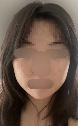 after photo: 사각턱보톡스