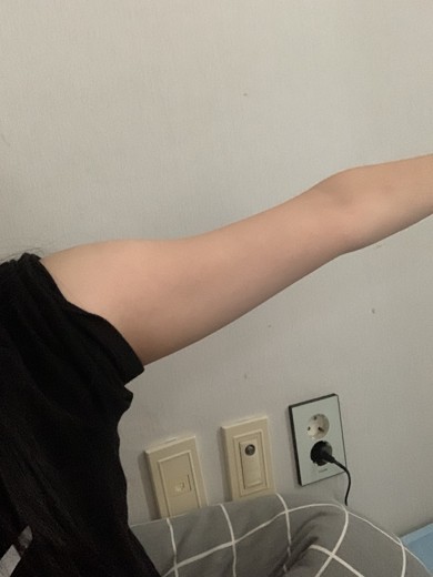 after photo: 팔지방분해주사